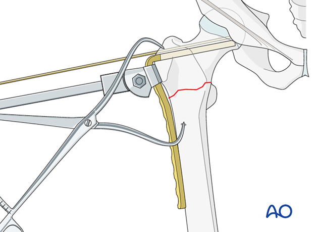 Blade insertion during fixation of an intertrochanteric fracture with an angled blade plate