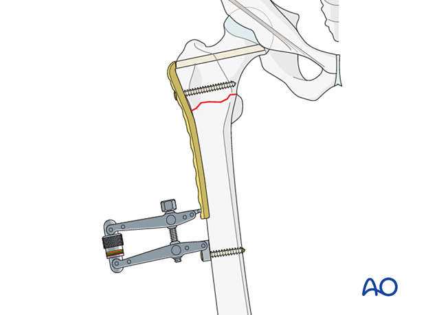 Articular tension device for compression of an intertrochanteric fracture during fixation with an angled blade plate