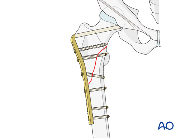 Intertrochanteric fracture fixed with an angled blade plate and lag screw