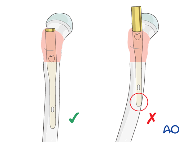 Anterior bowing of the femur may increase the risk of impingement of the nail tip with the cortex during nail insertion