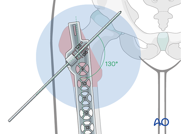 Determination of the neck-shaft angle for selection of the correct intramedullary nail for fixation of a trochanteric fracture