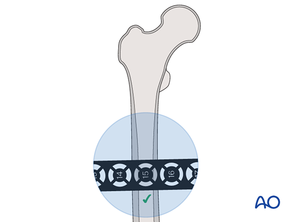 Determining the intramedullary diameter of the femur at the level of the nail tip