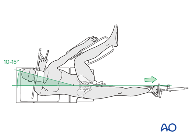 Patient placed supine on a fracture table with the ipsilateral hip adducted to allow nail entrance in the femoral shaft