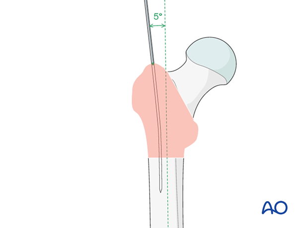 Guide-wire insertion for intramedullary nailing of a trochanteric fracture