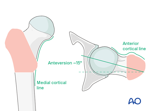 Patterns in AP and lateral view for acceptable reduction of trochanteric fractures