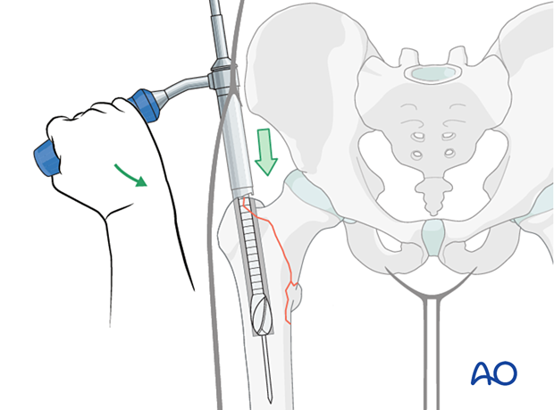 Reaming the medullary canal for intramedullary nailing of a trochanteric fracture