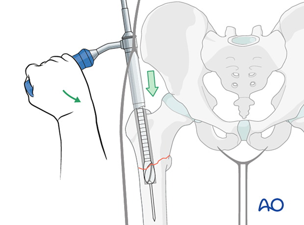 Reaming the medullary canal for intramedullary nailing of a trochanteric fracture