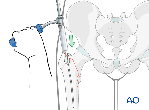 Opening the trochanter with a reamer for intramedullary nailing of a trochanteric fracture