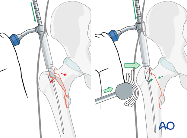 Opening the trochanter with a reamer for intramedullary nailing of a trochanteric fracture with counteracting the lateral displacement forces