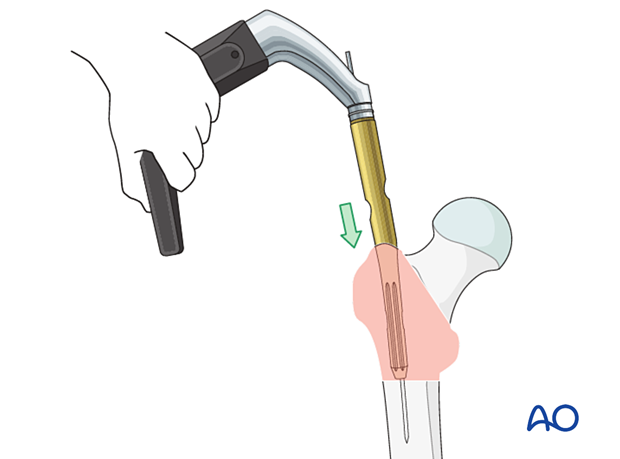 Nail insertion during intramedullary nailing of a trochanteric fracture