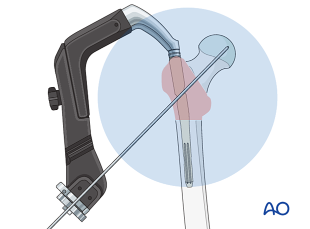 Confirming correct nail insertion depth for intramedullary nailing of a trochanteric fracture