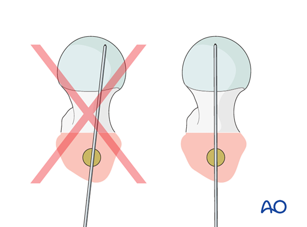 Confirming correct nail insertion depth for intramedullary nailing of a trochanteric fracture