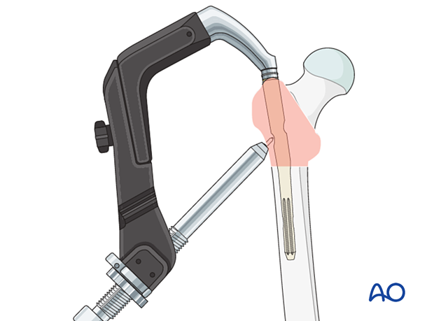 Guide-wire insertion during intramedullary nailing of a trochanteric fracture