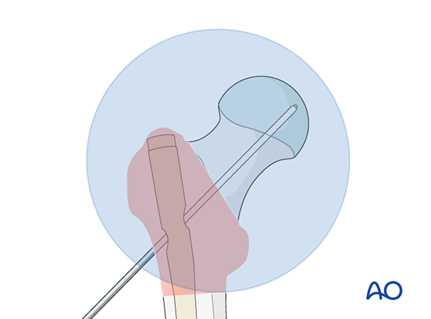 Guide-wire insertion during intramedullary nailing of a trochanteric fracture