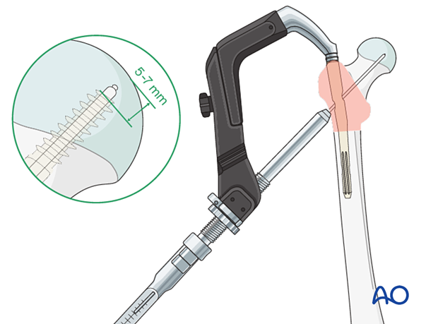 Measuring blade/screw length for intramedullary nailing of a trochanteric fracture