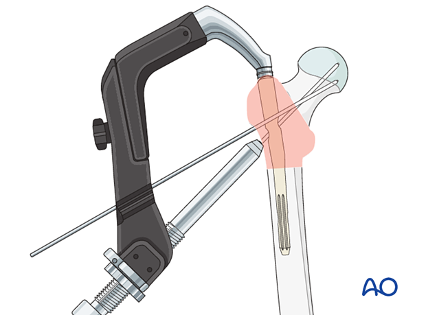 Insertion of an antirotation wire during intramedullary nailing of a trochanteric fracture