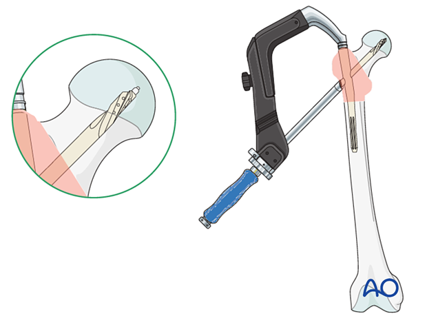 Blade insertion during intramedullary nailing of a trochanteric fracture