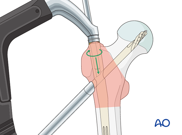 Locking of blade rotation during intramedullary nailing of a trochanteric fracture