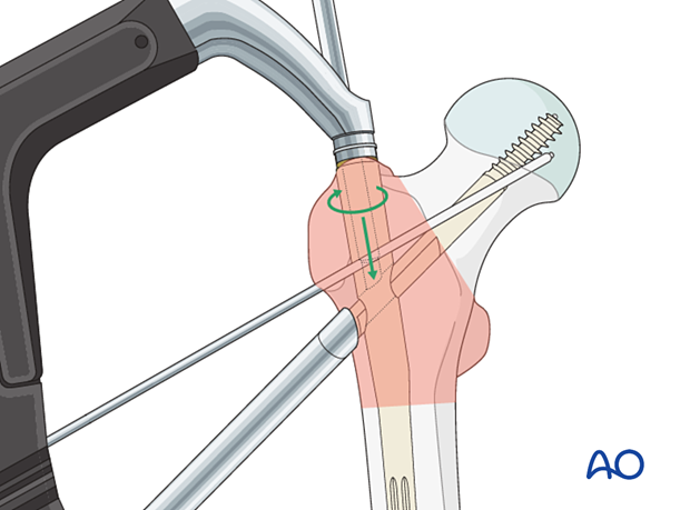 Locking of blade rotation during intramedullary nailing of a trochanteric fracture