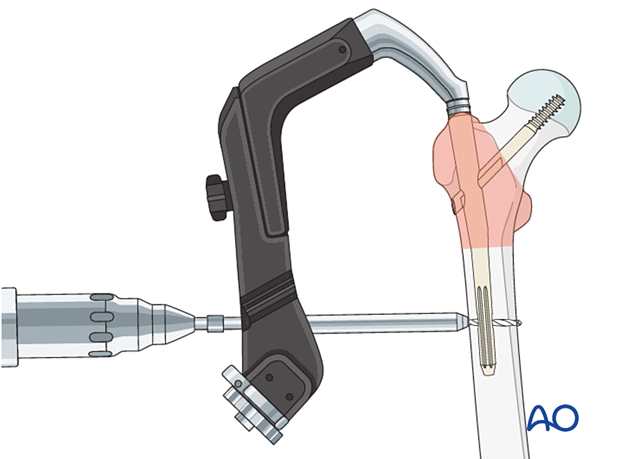 Drilling for distal locking screw during intramedullary nailing of a trochanteric fracture