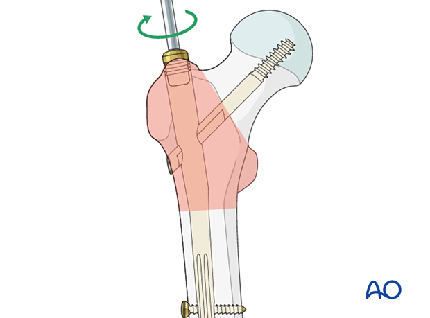 Insertion of end cap during intramedullary nailing of a trochanteric fracture