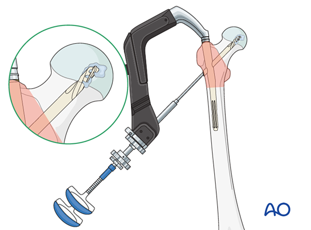 Augmentation in intramedullary nailing of a trochanteric fracture of a severe osteoporotic bone 