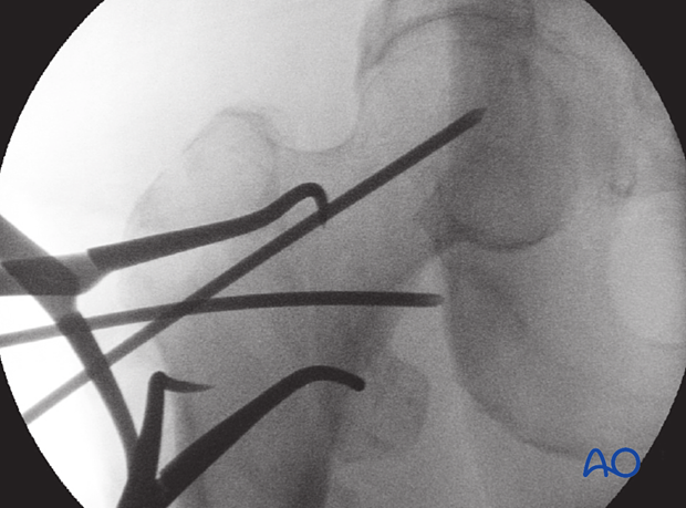 AP view of trochanteric fracture reduction with pointed reduction forceps and K-wires for preliminary stabilization