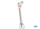 Intertrochanteric fracture fixed with a long intramedullary nail