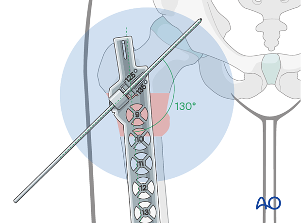 Determination of the neck-shaft angle for selection of the correct intramedullary nail for fixation of an intertrochanteric fracture