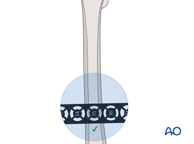 Determining the intramedullary diameter of the femur at the level of the isthmus