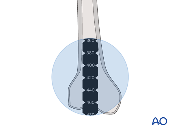 Determination of the nail length for fixation of an intertrochanteric fracture