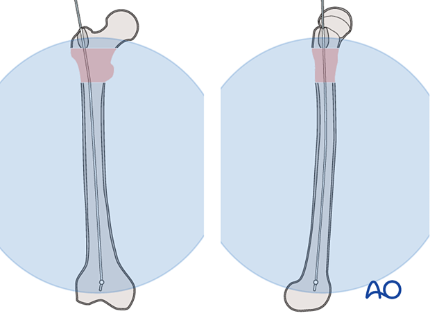 Ball-tipped wire for reaming the medullary canal to nail an intertrochanteric fracture