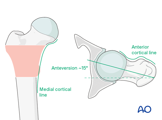 Patterns in AP and lateral view for acceptable reduction of intertrochanteric fractures