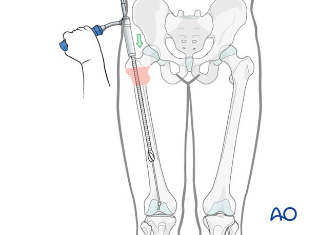 Reaming the medullary canal to nail an intertrochanteric fracture