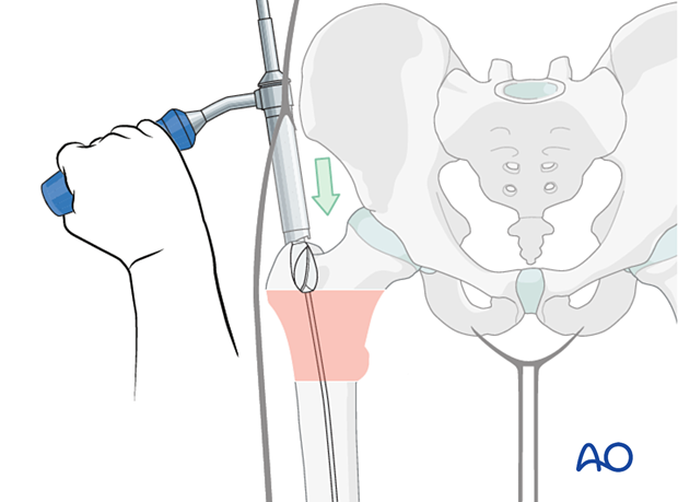 Opening the trochanter with a reamer for intramedullary nailing of an intertrochanteric fracture