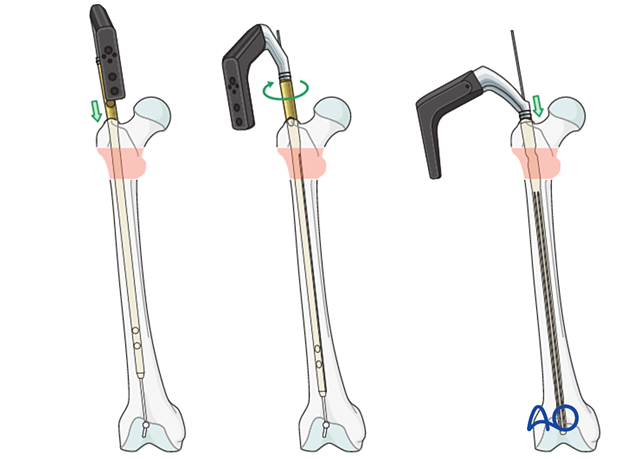 Nail insertion for fixation of an intertrochanteric fracture