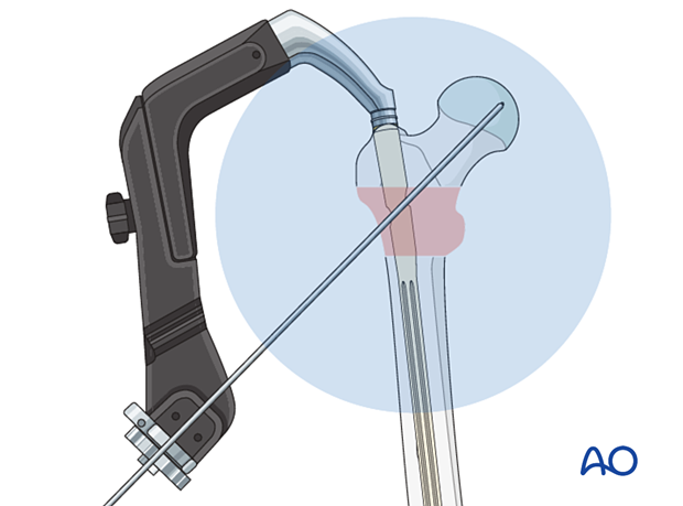 Confirming correct nail insertion depth for intramedullary nailing of an intertrochanteric fracture