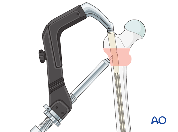 Guide-wire insertion during intramedullary nailing of an intertrochanteric fracture