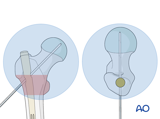 Guide-wire insertion during intramedullary nailing of an intertrochanteric fracture