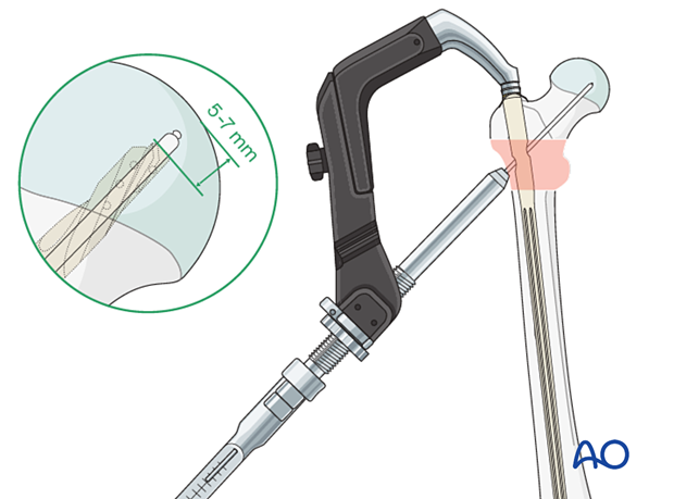 Measuring blade/screw length for intramedullary nailing of an intertrochanteric fracture