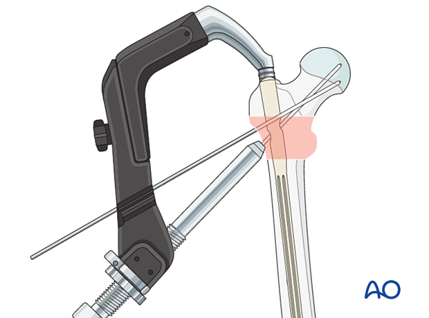 Insertion of an antirotation wire during intramedullary nailing of an intertrochanteric fracture