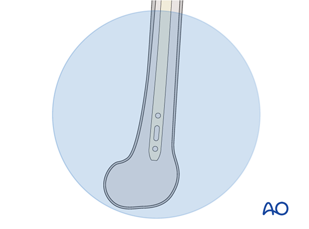 Confirming correct position of the nail and rotation of the femur with an image intensifier before distal locking