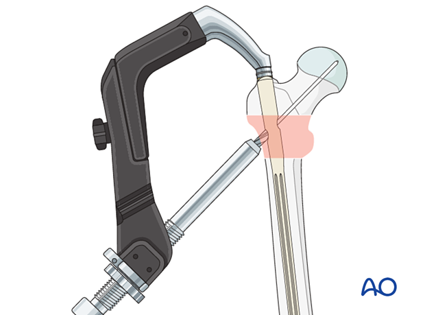 Drilling for blade insertion during intramedullary nailing of an intertrochanteric fracture