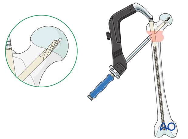 Blade insertion during intramedullary nailing of an intertrochanteric fracture