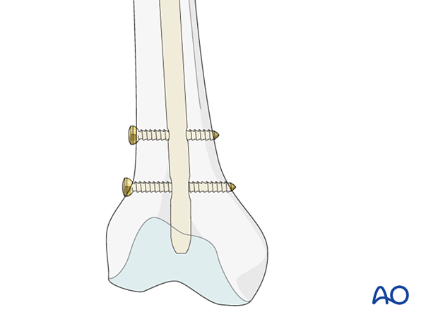 Distal locking with two screw of a femoral nail