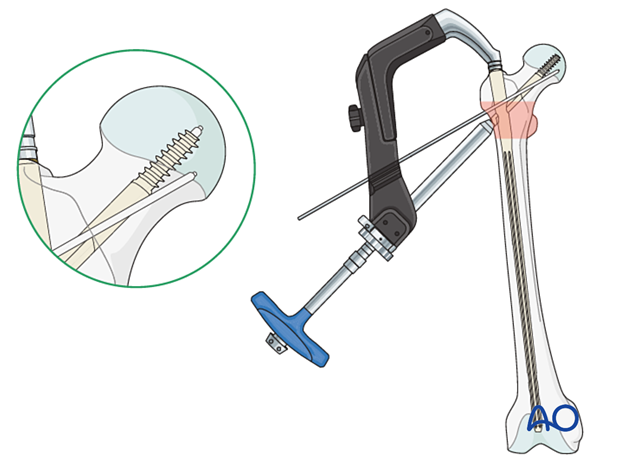 Lag screw insertion during intramedullary nailing of an intertrochanteric fracture