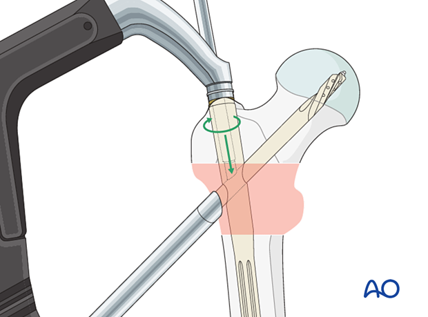 Locking of blade rotation during intramedullary nailing of an intertrochanteric fracture