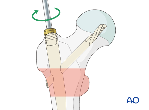 Insertion of end cap during intramedullary nailing of an intertrochanteric fracture