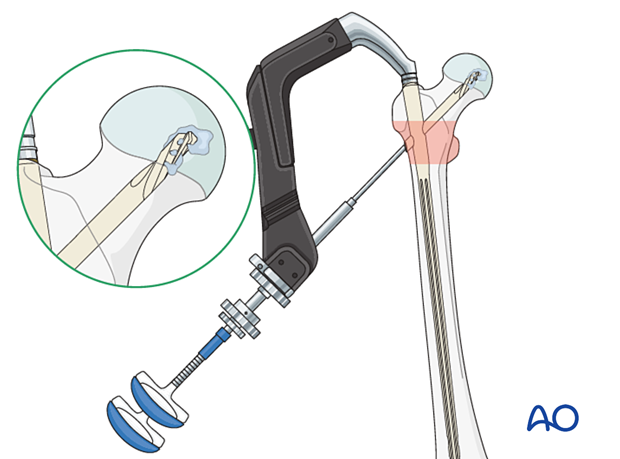 Augmentation in intramedullary nailing of an intertrochanteric fracture of a severe osteoporotic bone