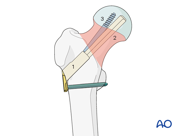 Femoral neck fracture fixed with a femoral neck system